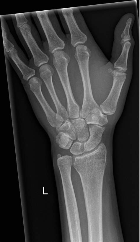 wrist xrays left - Google Search in 2020 | Okay gesture, Wrist