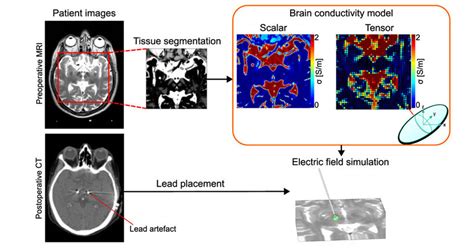 2: Overview of the patient specific electric field simulation workflow.... | Download Scientific ...