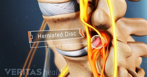 Cervical Herniated Disc Symptoms and Treatment Options