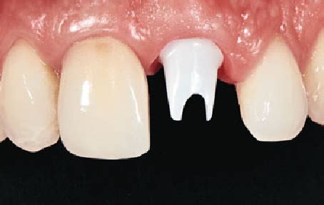 Zirconia abutment at 2.1. | Download Scientific Diagram