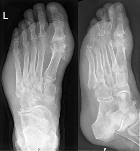 Gout: Symptoms, Causes, and Treatments | Southwest Florida Rheumatology