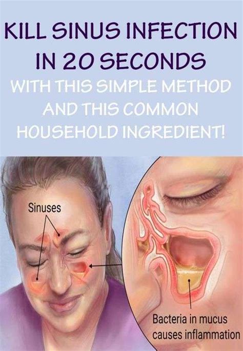 How To Relieve Tooth Pain Caused By Sinus Infection - HealthySinus.net (2022)