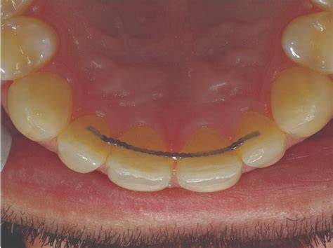 Direct Esthetic Restoration – The Case of The Lingual Wire – Morning Huddle