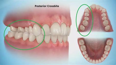 What is a Crossbite