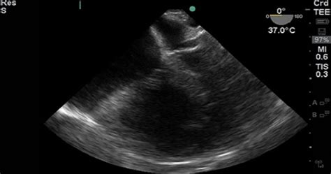 Cardiac Imaging 2 - Transesophageal Echocardiography (TEE) (English ...