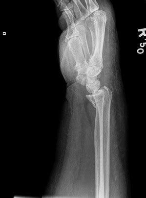 Retromolar Pad Radiograph