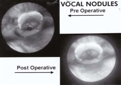 Direct laryngoscopic photograph showing vocal nodules pre and post... | Download Scientific Diagram