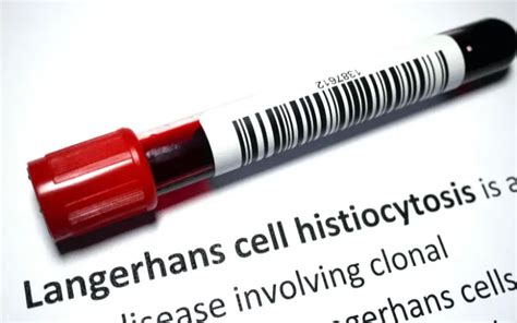 Langerhans Cell Histiocytosis: What the Top 10 Symptoms Tell Us