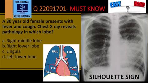 Silhouette Chest X Ray