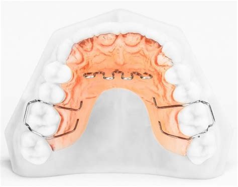 Tongue Crib – BM Ortho Appliances Inc.