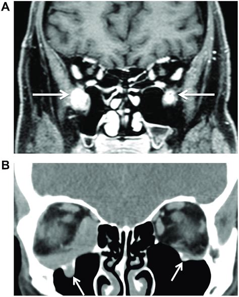 (A) Apparent bilateral infraorbital canal and nerve infiltration... | Download Scientific Diagram