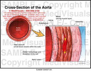 Cross-Section of the Aorta Medical Exhibit Medivisuals