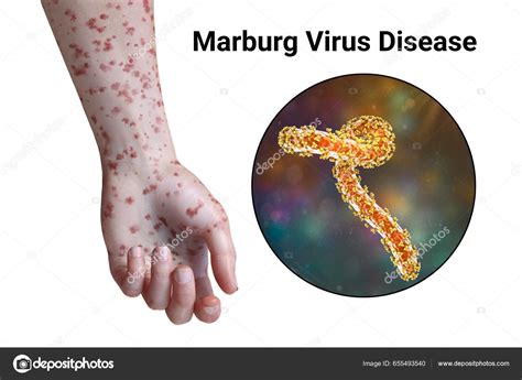 Skin Rash Arm Patient Marburg Hemorrhagic Fever Close View Marburg ...