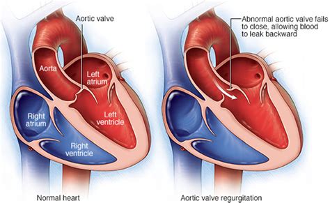 Aortic Valve Regurgitation - Causes, Symptoms, Treatment