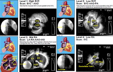 Part 1 Radial Intracardiac Echocardiography in the EP Lab: Right Atrial ...