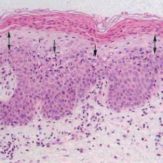 Necrolytic migratory erythema with typical scaling, erythema and... | Download Scientific Diagram