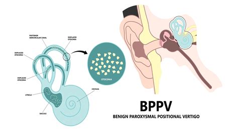 What is BPPV or crystals in the inner ear? — 3D Physiotherapy Health Group Bendigo | Physio ...