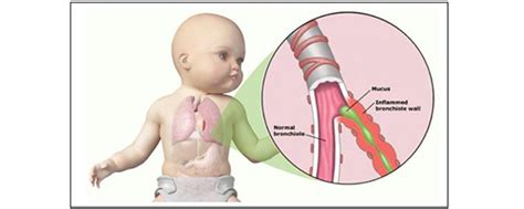 How to Care for Your Child with Bronchiolitis | Sidra Medicine