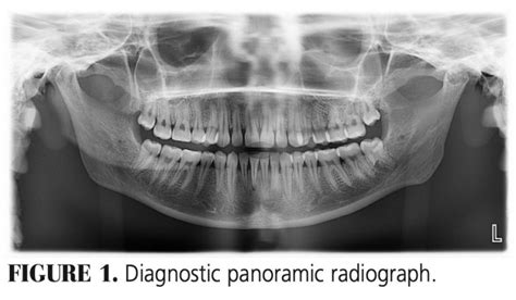 Optimal Panorex Imaging - Decisions in Dentistry