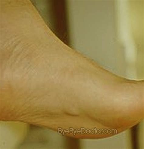 Plantar Fibromatosis – Symptoms, Causes, Pictures, Treatment ...