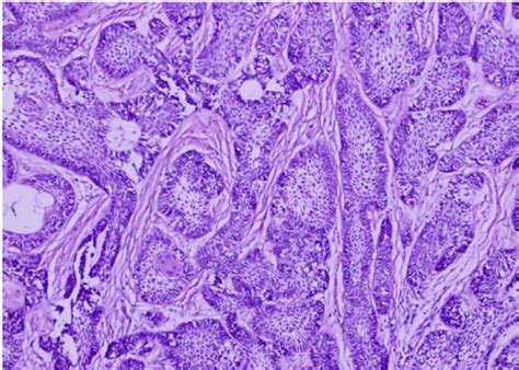 Ameloblastoma Histology