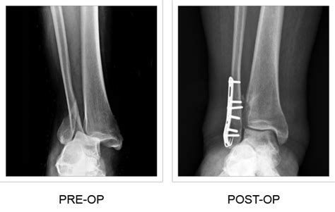 Ankle Hook Plate - Fibula & Tibia Fracture Implant - TriMed Inc.