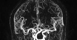 Ultimate Radiology : Dolichoectasia of the Vertebrobasilar System