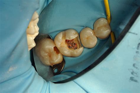 Top tips on endodontics – obturation and restoration - Dentistry.co.uk