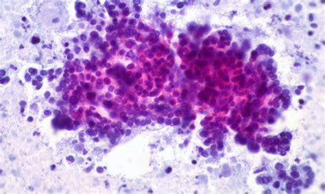 Disrupting cellular pH balance blocks pancreatic cancer • healthcare-in-europe.com