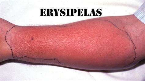 ERYSIPELAS : DEFINITION ,CLINICAL FEATURES & COMPLICATIONS - Humainology