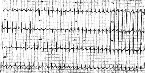 EKG showing ectopic atrial tachycardia (right atrial crista) at rate of... | Download Scientific ...