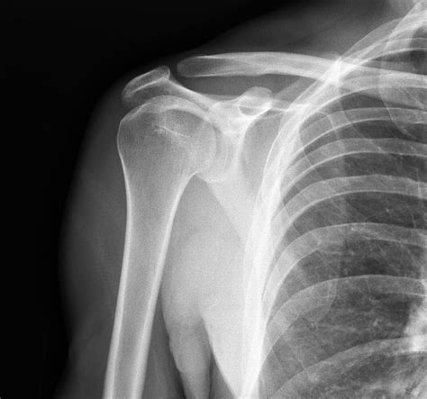 X-ray of shoulder joint. - Irvings Law