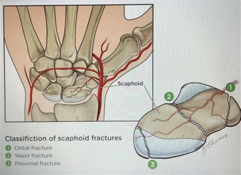 Scaphoid Fracture Avascular Necrosis