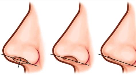 Non Surgical Nose Job Risks - Deviated Septum Information & Advice