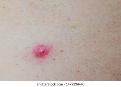 Close Photo Nodular Cystic Acne Skin Stock Photo 1479234440 | Shutterstock