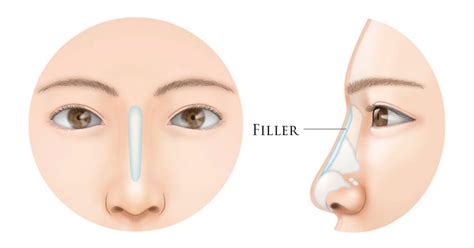 Everything You Need To Know Before Getting Nose Filler