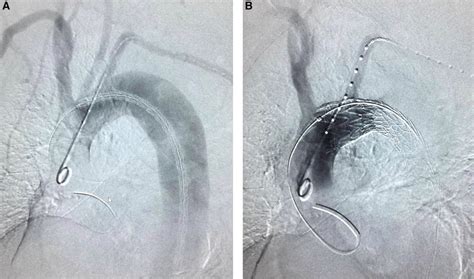 Complications of TAG and Conformable TAG (CTAG) Thoracic Endoprosthesis | Thoracic Key