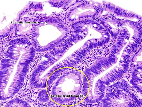 Colon polyps pathophysiology - wikidoc