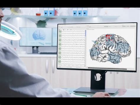 cortiQ Brain Mapping with ECoG - Epilepsy & Brain Tumor Surgery - YouTube