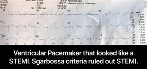 Ventricular Pacemaker that looked like a STEMI. Sgarbossa criteria ...