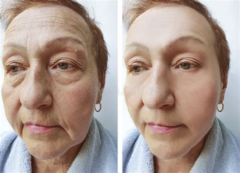 Old Woman Wrinkles before and after Treatments Stock Photo - Image of aging, facial: 132951584
