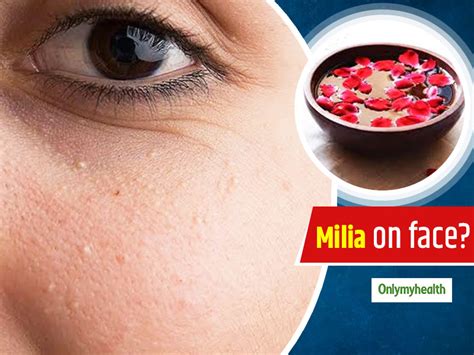 Having Milia On Your Face? Here Are 10 Useful Home Remedies To Get Rid Of Them | OnlyMyHealth