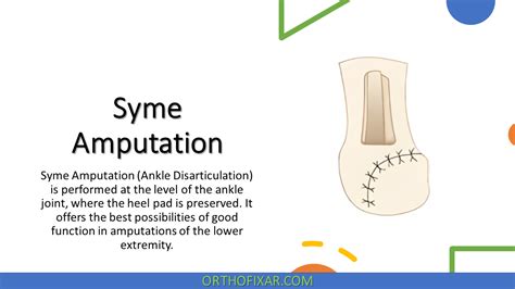 Syme Amputation & Prosthesis | OrthoFixar 2024