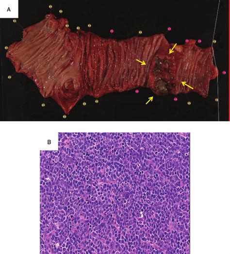 A, Photograph of the surgical specimen in the terminal ileum and B ...