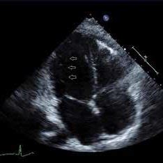 b: Parasternal short axis view at the level of papillary muscles shows ...