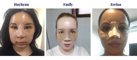 Recovery Process for Rhinoplasty: Timeline, photos and more