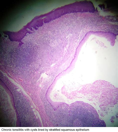 Epidermoid Cyst Histology