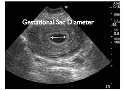 Yolk Sac Ultrasound