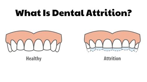 What Is Dental Attrition? Treatment At Spring Orchid Dental