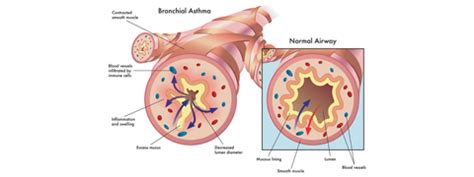 Bronchoconstriction: Causes, Symptoms And Treatment